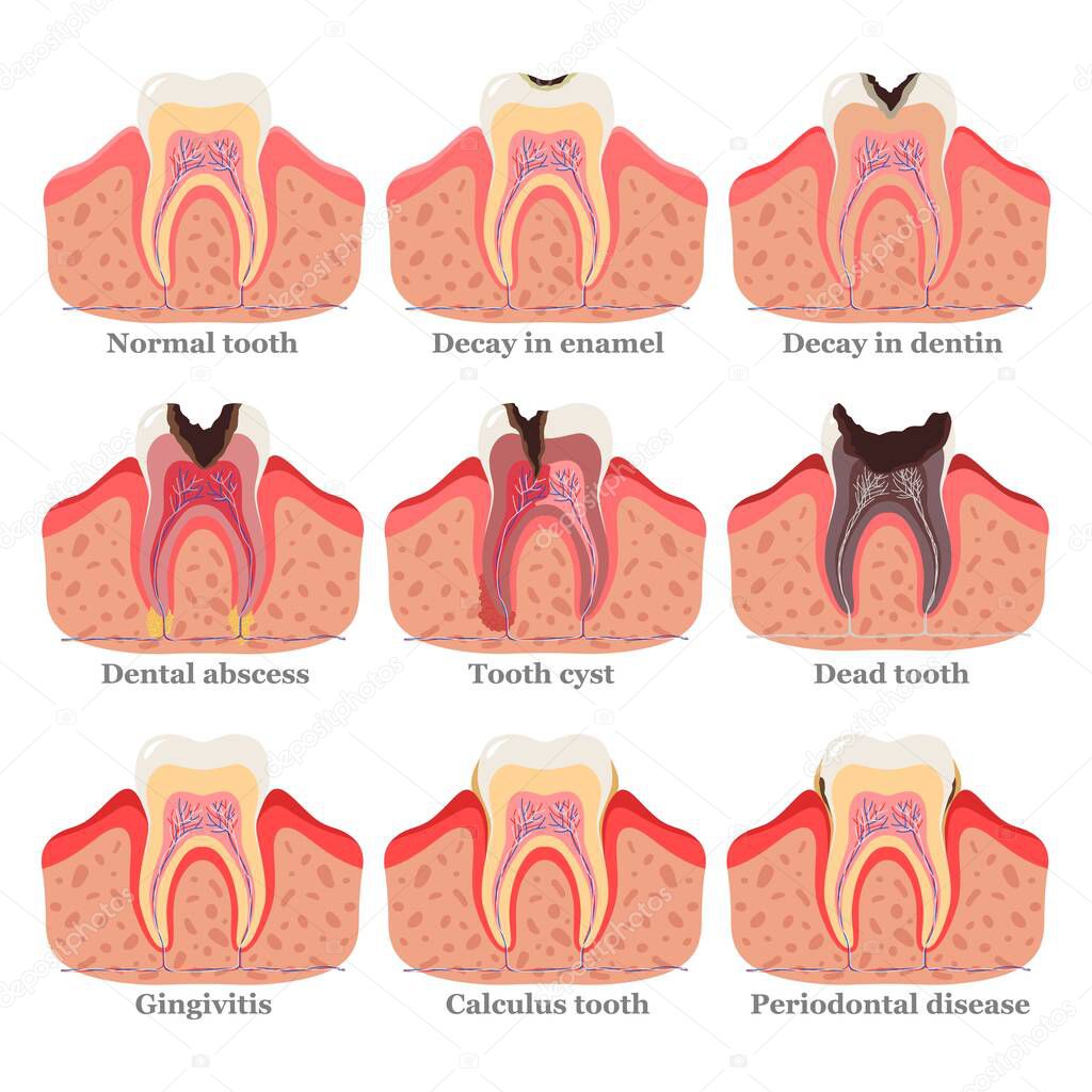 Tooth disorders set, flat vector illustration. Healthy and unhealthy teeth. Dental problems and diseases.