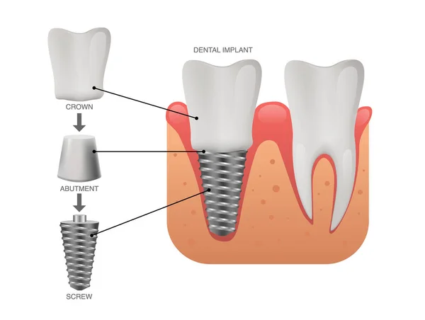 Estructura Del Implante Dental Dientes Humanos Implante Dental Ilustración Vectorial — Vector de stock