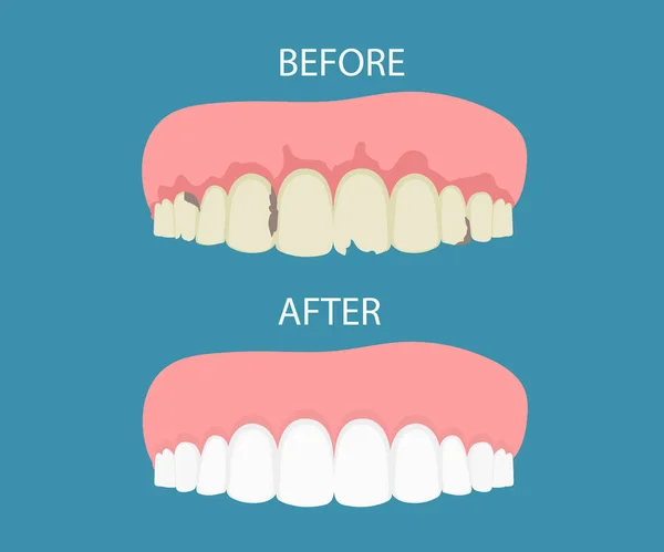 Trattamenti Dentali Prima Dopo Sbiancamento Concetto Cura Orale Pulizia Profonda — Vettoriale Stock