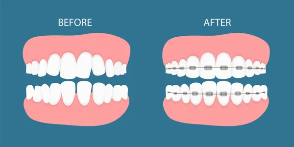 Illustrazione vettoriale delle fasi del trattamento ortodontico dei denti. Denti prima, dopo l'apparecchio. Sfondo in stile piano.vettore su sfondo blu. Concetto dentale. — Vettoriale Stock