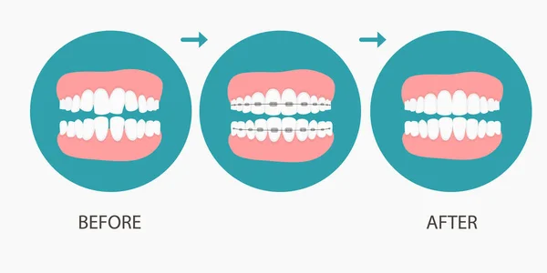 Illustrazione vettoriale delle fasi del trattamento ortodontico dei denti. Denti prima, dopo l'apparecchio. Sfondo in stile piano.vettore su sfondo blu. Concetto dentale. — Vettoriale Stock