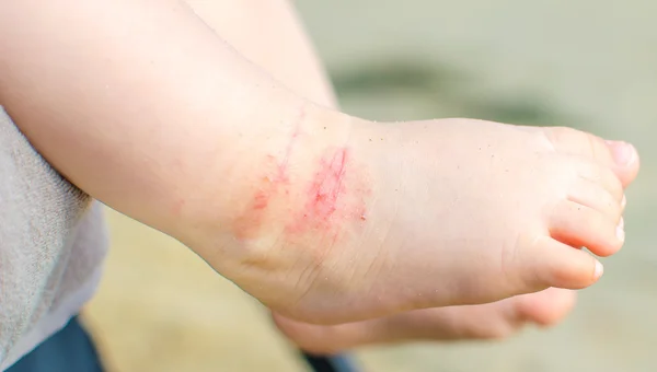 kaşıntılı Dermatit Atopik bebek ayak