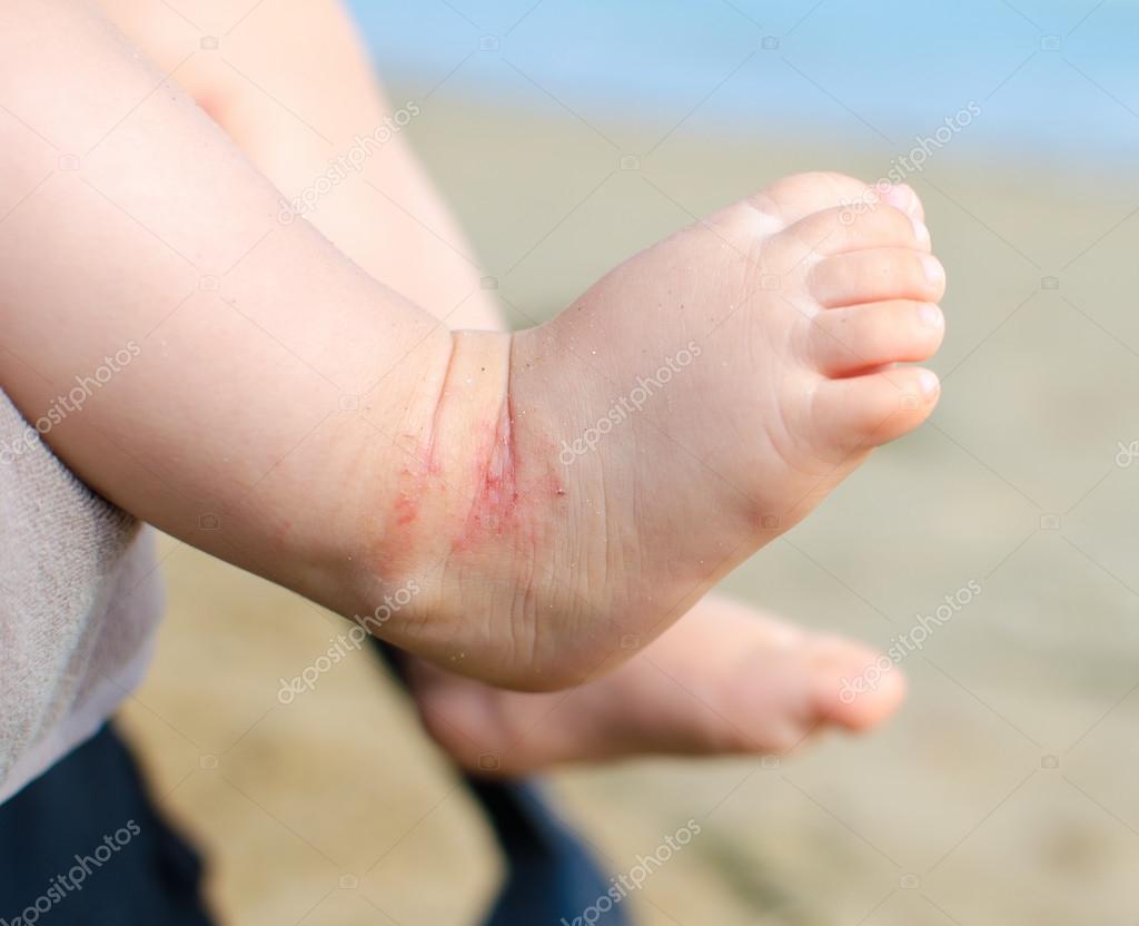 Atopic dermatitis newborn feet eczema Stock Photo by ©philfreezgmail