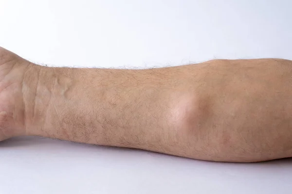 Lipoma, a benign neoplasm, a tumor on the forearm of a Caucasian man on a white background