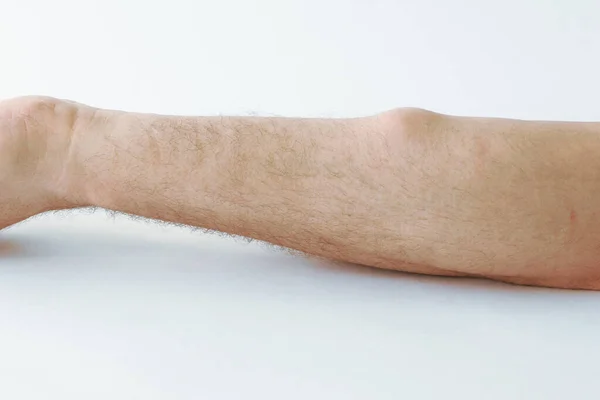 Lipoma, a benign neoplasm, a tumor on the forearm of a Caucasian man on a white background — Stock Photo, Image