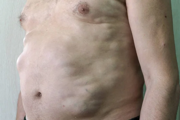 Multiple lipomas, benign neoplasms, tumors on the body of a Caucasian male