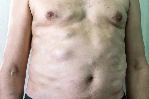 Multiple lipomas, benign neoplasms, tumors on the body of a Caucasian male 图库图片