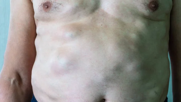 脂肪瘤身体上有良性肿瘤的男人.多发性脂肪瘤 图库图片