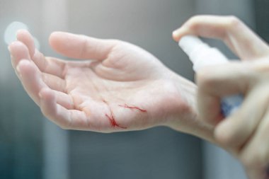 Kadınların elindeki yarayı kapat ve evdeki temel mikrop önleme için alkol spreyi kullan.
