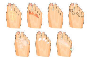the various injuries of the feet. fungus, burning, warts, sweating. as well as soap, lotion, and spray clipart