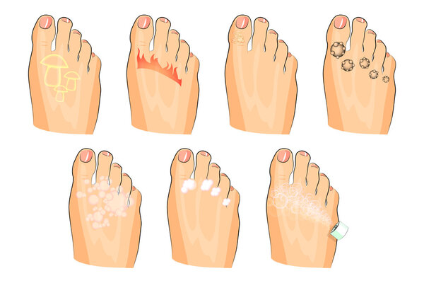 различные травмы ног. грибок, жжение, бородавки, пот. а также мыло, лосьон и спрей
