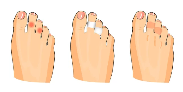 Ilustración de callos en los dedos de los pies — Archivo Imágenes Vectoriales