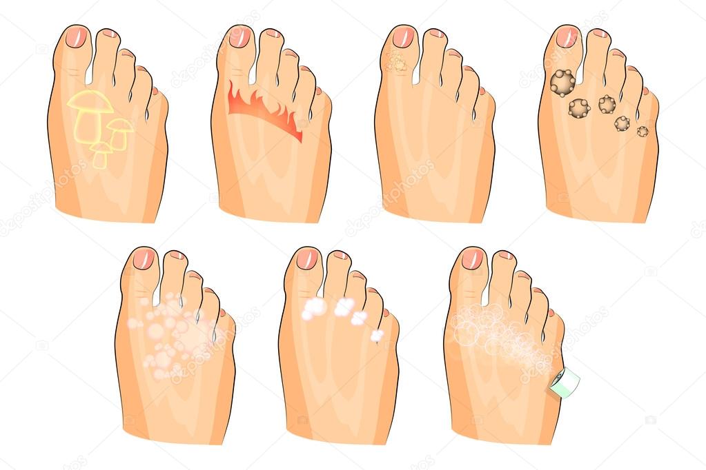 the various injuries of the feet. fungus, burning, warts, sweating. as well as soap, lotion, and spray