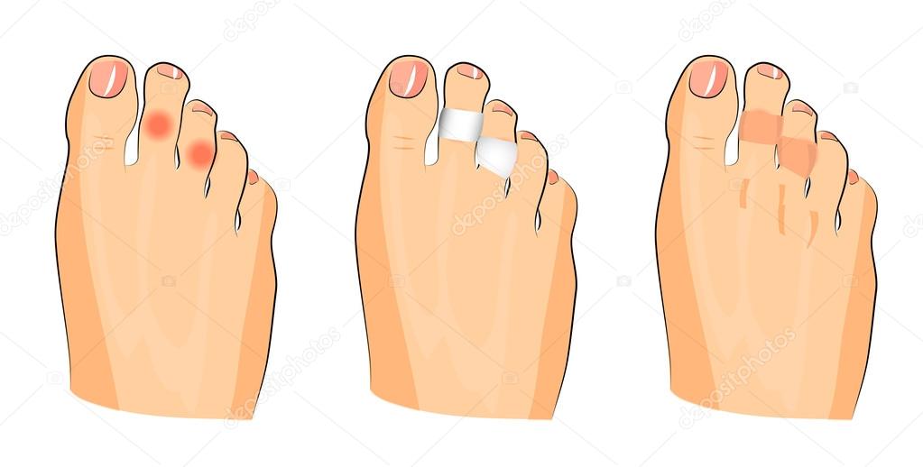 illustration of corns on the toes