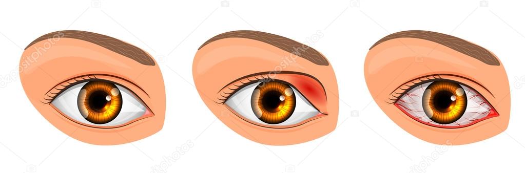 eye suffering from conjunctivitis and styes
