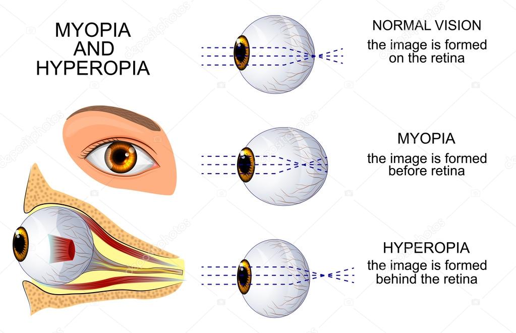 Myopia és hyperopia: mi ez? okok, megelőzés, korrekció - Myopia és hyperopia cikk