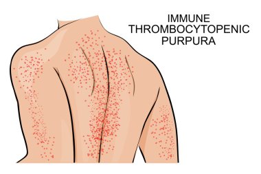 the skin lesions in immune thrombocytopenic purpura clipart
