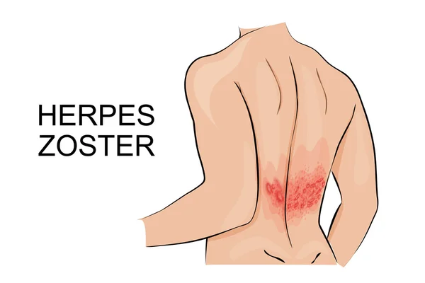 Infecção humana herpes zoster —  Vetores de Stock