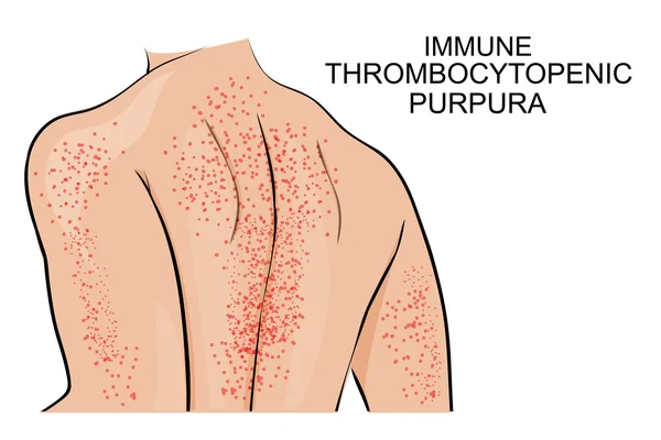 Lésions cutanées dans le purpura thrombopénique immunitaire — Image vectorielle