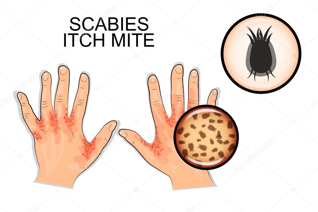 the infection of scabies. itch mite