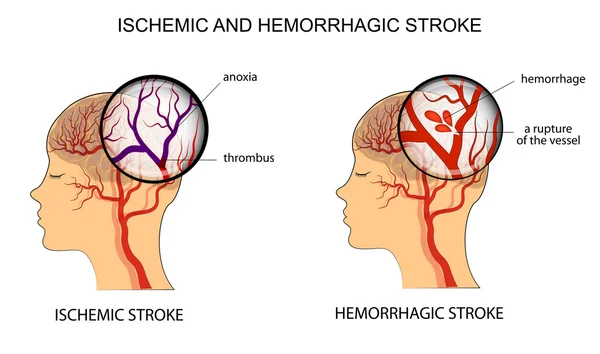 Ischaemiás és a vérzéses Stroke — Stock Vector