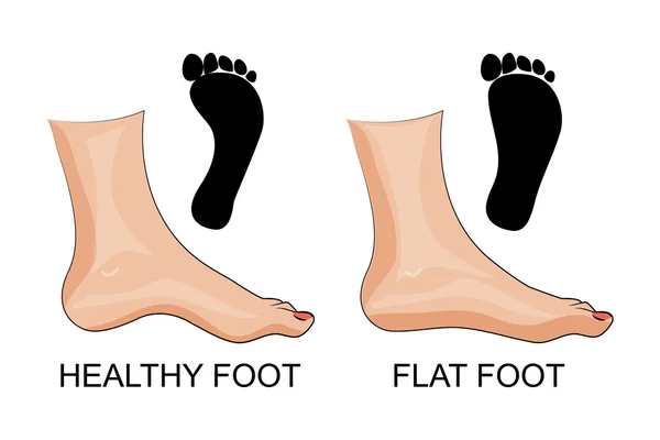 Ноги здоровые и плоские ноги. отпечаток — стоковый вектор