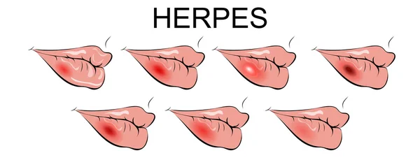 Lip herpes. blaas, ontsteking — Stockvector