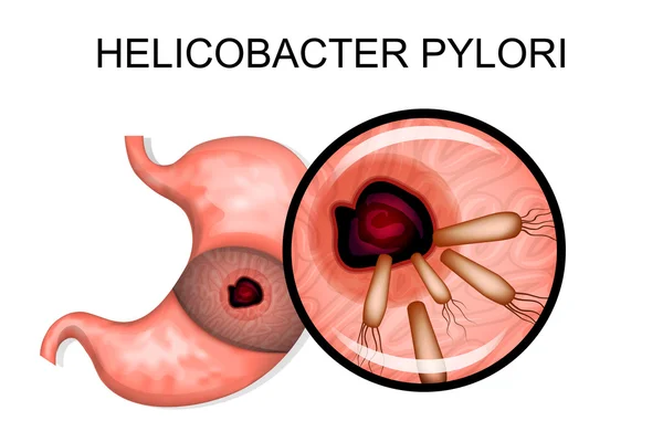 Pathology of the stomach. Helicobacter pylori — Stock Vector