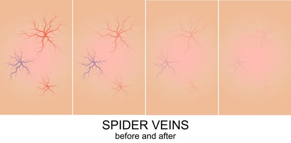 Pele com veias de aranha — Vetor de Stock