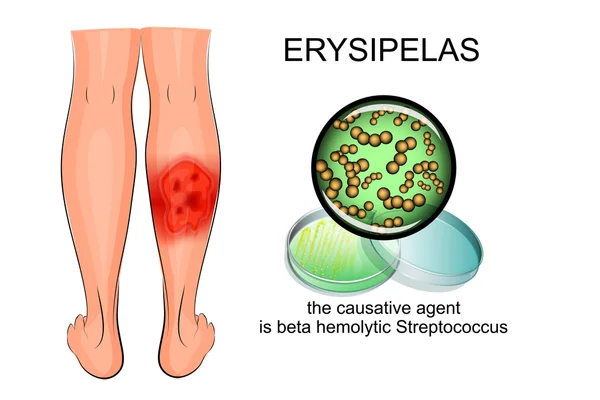 Erysipelas 的小腿 — 图库矢量图片