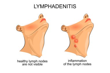 lymphadenitis . inflammation of the lymph nodes clipart