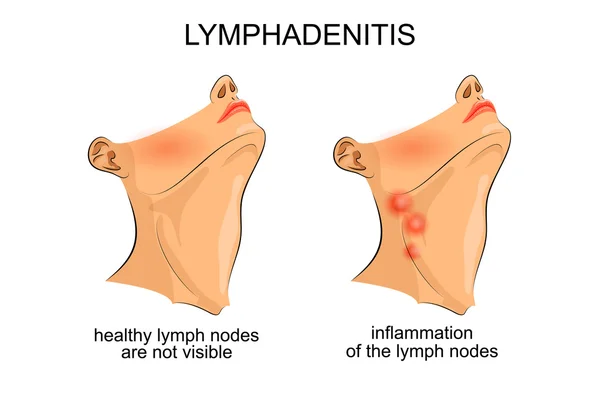 Linfadenite. inflamação dos nódulos linfáticos —  Vetores de Stock