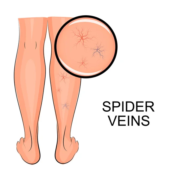 Veias de aranha em pernas —  Vetores de Stock