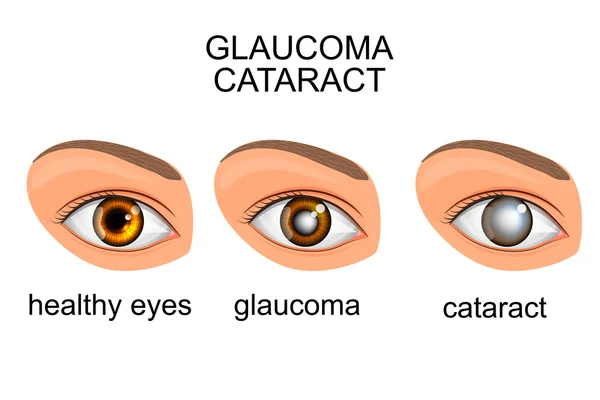 Ojos sanos, glaucoma, cataratas — Vector de stock