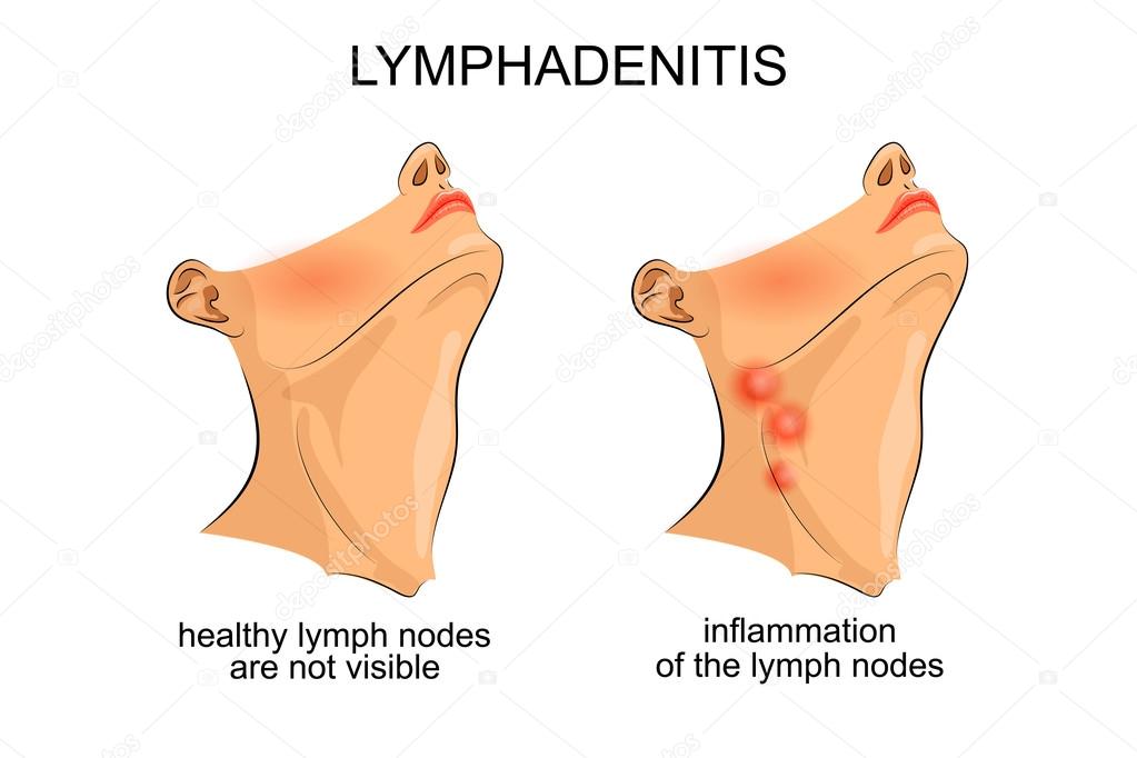 lymphadenitis . inflammation of the lymph nodes
