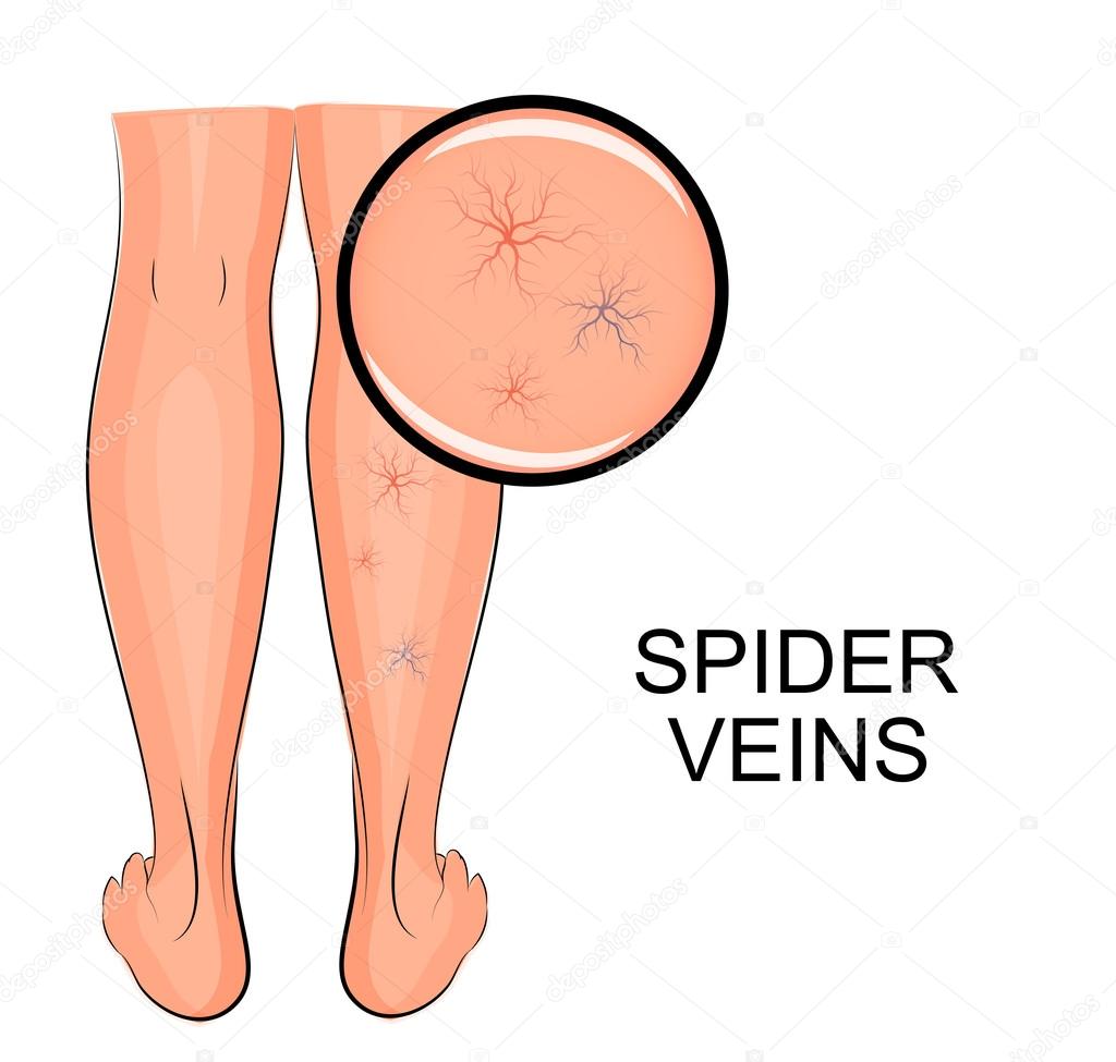 Spider veins on legs Stock Vector Image by ©Artemida-psy #102362086
