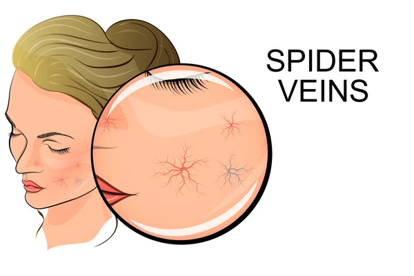 Rosto feminino com veias de aranha — Vetor de Stock