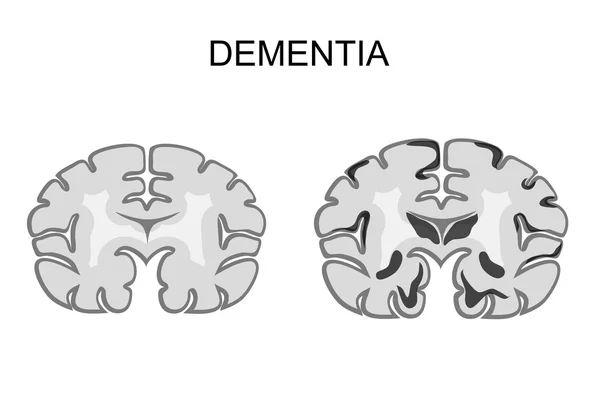 Demencia, enfermedad de Alzheimer. patogénesis — Archivo Imágenes Vectoriales