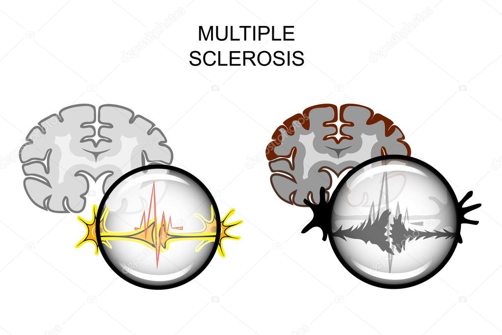 multiple sclerosis of the brain