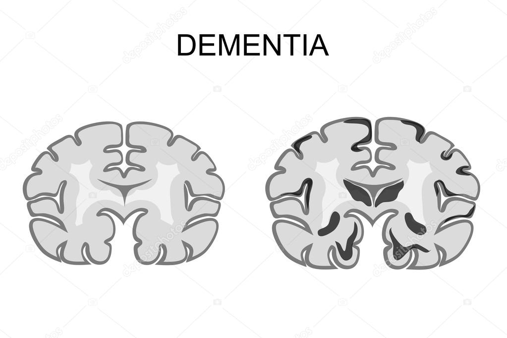 dementia, Alzheimer s disease. pathogenesis