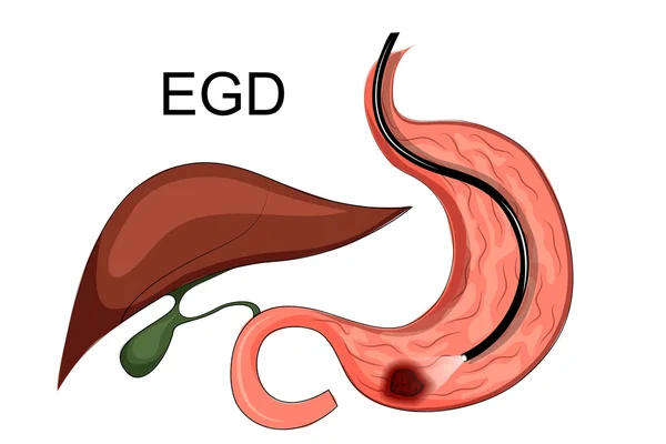 Ulcer of the stomach. EGD — Stock Vector