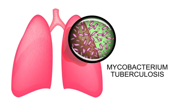 Легені хворих на туберкульоз. Koha — стоковий вектор