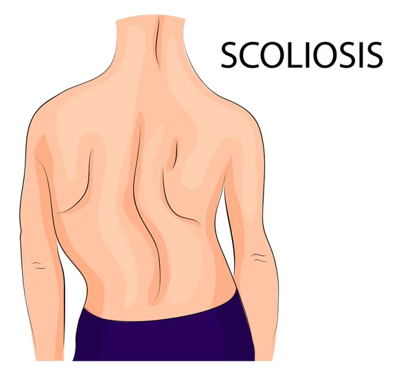 Back, a scoliosis of the fourth degree — Stock Illustration Back, a scoliosis of the fourth degree Stock Illustration