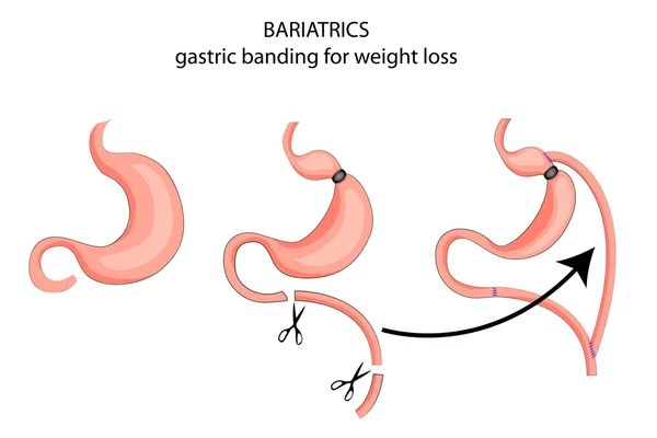 Bariatrics. a fogyás céljait Sávszórású Gyomor. — Stock Vector