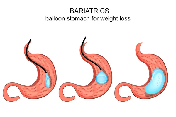 Bariatrics。气球胃减肥 — 图库矢量图片