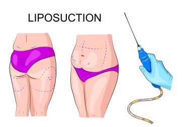 kadın bedeni ve liposuction için işaretler