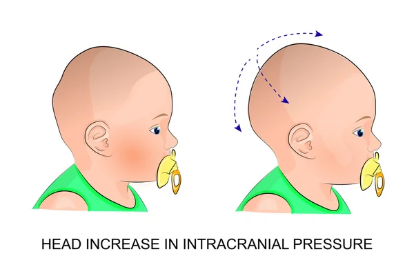 The babys head during intracranial pressure — Stock Vector