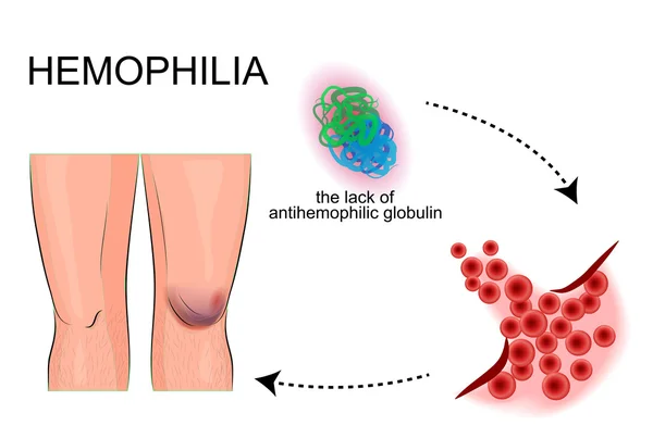 The joints hemophilia. bleeding. injury. — Stock Vector