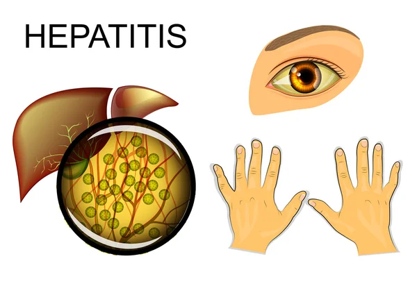 Leber, Hepatitis und Gelbfärbung von Augen und Händen — Stockvektor