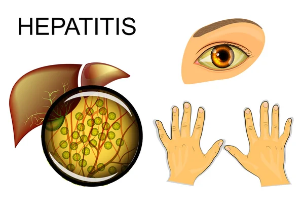 Hígado, hepatitis y coloración amarillenta de ojos y manos — Vector de stock